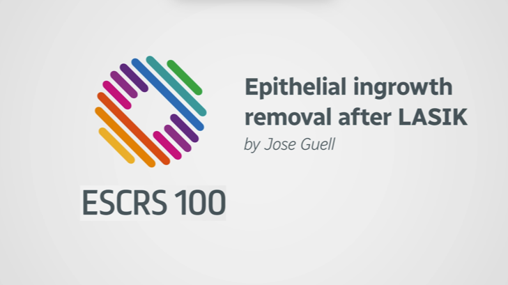 Epithelial ingrowth removal after LASIK - Jose Guell