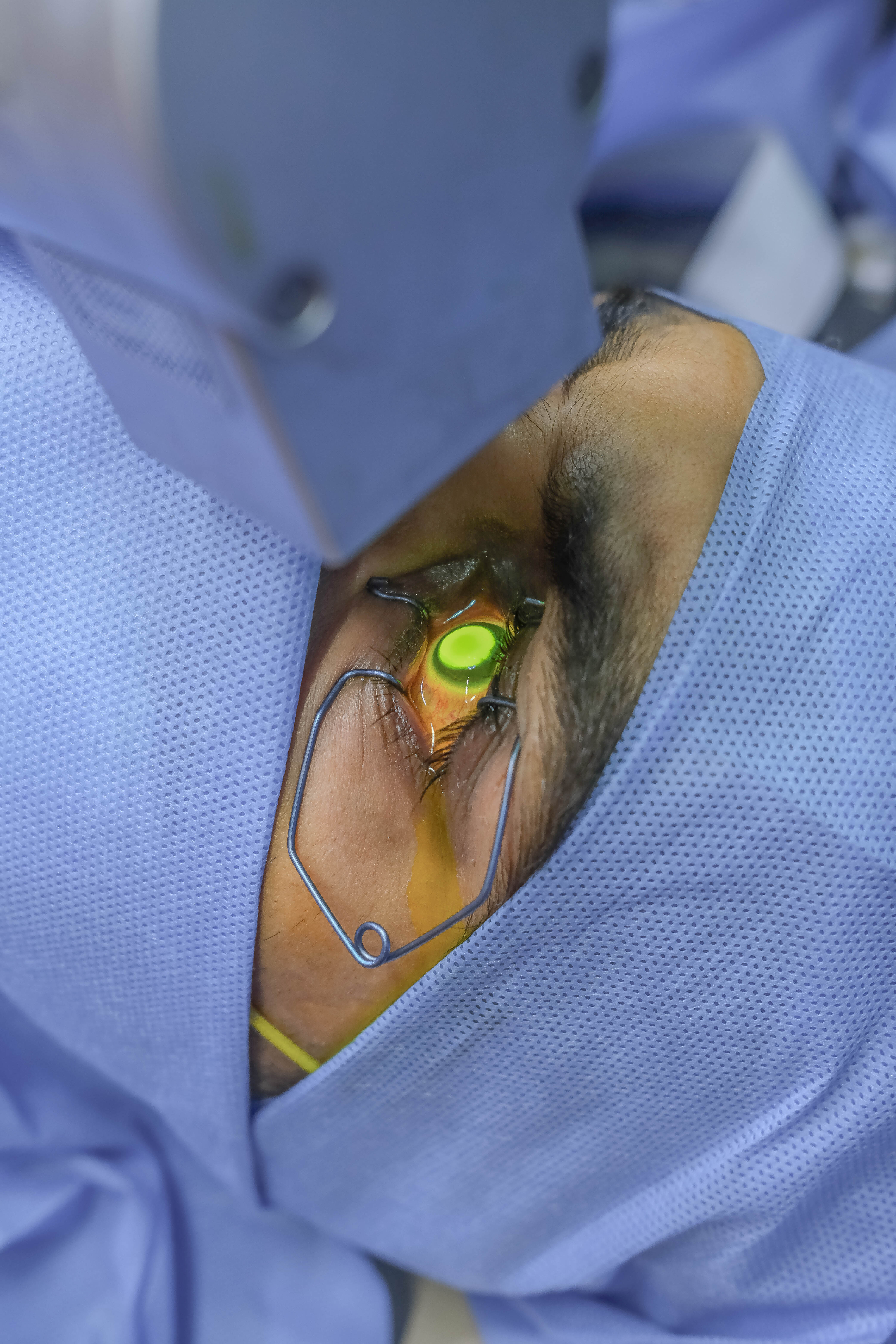 Treating Ectasia Without Keratoplasty
