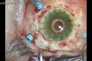 The management of pre-phthisical, post multiple retina surgery and failed keratoplasty eye with a Boston Type 1 keratoprosthesis and long-term heavy silicone