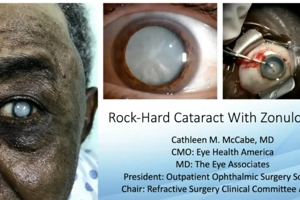 Complex Case #5: Dense cataract with zonulopathy & small pupil