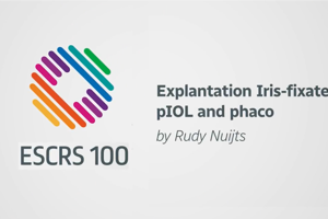 Explantation Iris-fixated pIOL and phaco - R Nuijts