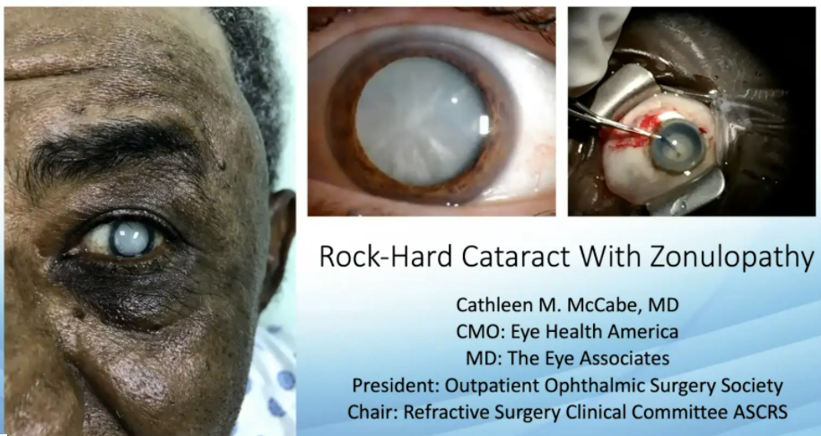 case study of cataract patient