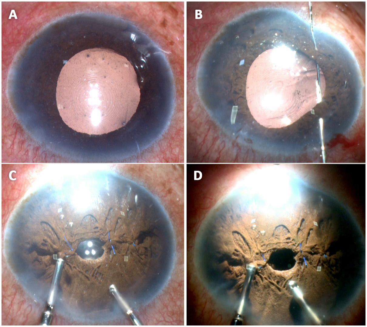 Need to Know: Wavefront Filtering and PPP for Aberropia