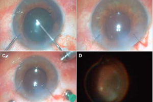 Cataract Surgery and Pars Plana Vitrectomy
