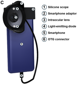 Smartphones Could Be Used To Screen For Cataracts And Other Eye Problems Ref 2