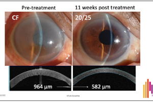 Innovations in Treatment for Corneal Endothelial Disease