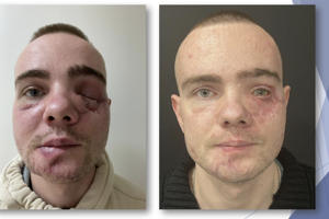 3D Printing Helps Transform Ukrainian Eye Care