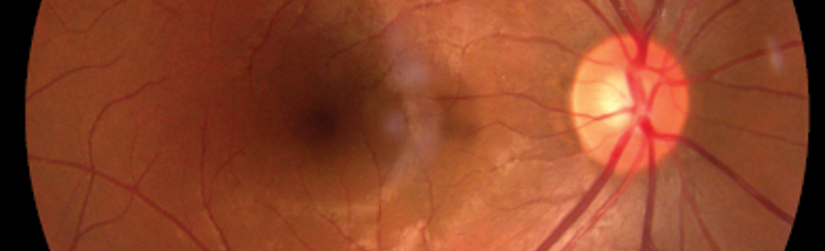 Banner image for Supplement: ESCRS Clinical Trends Series: Retina