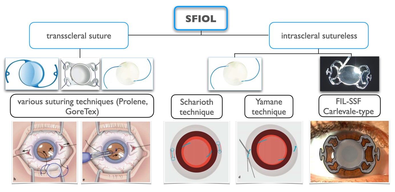 Surgery for IOL Luxation in Vitrectomised Eyes