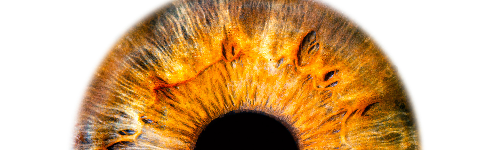 Knowing Iris Repair: Pupilloplasty