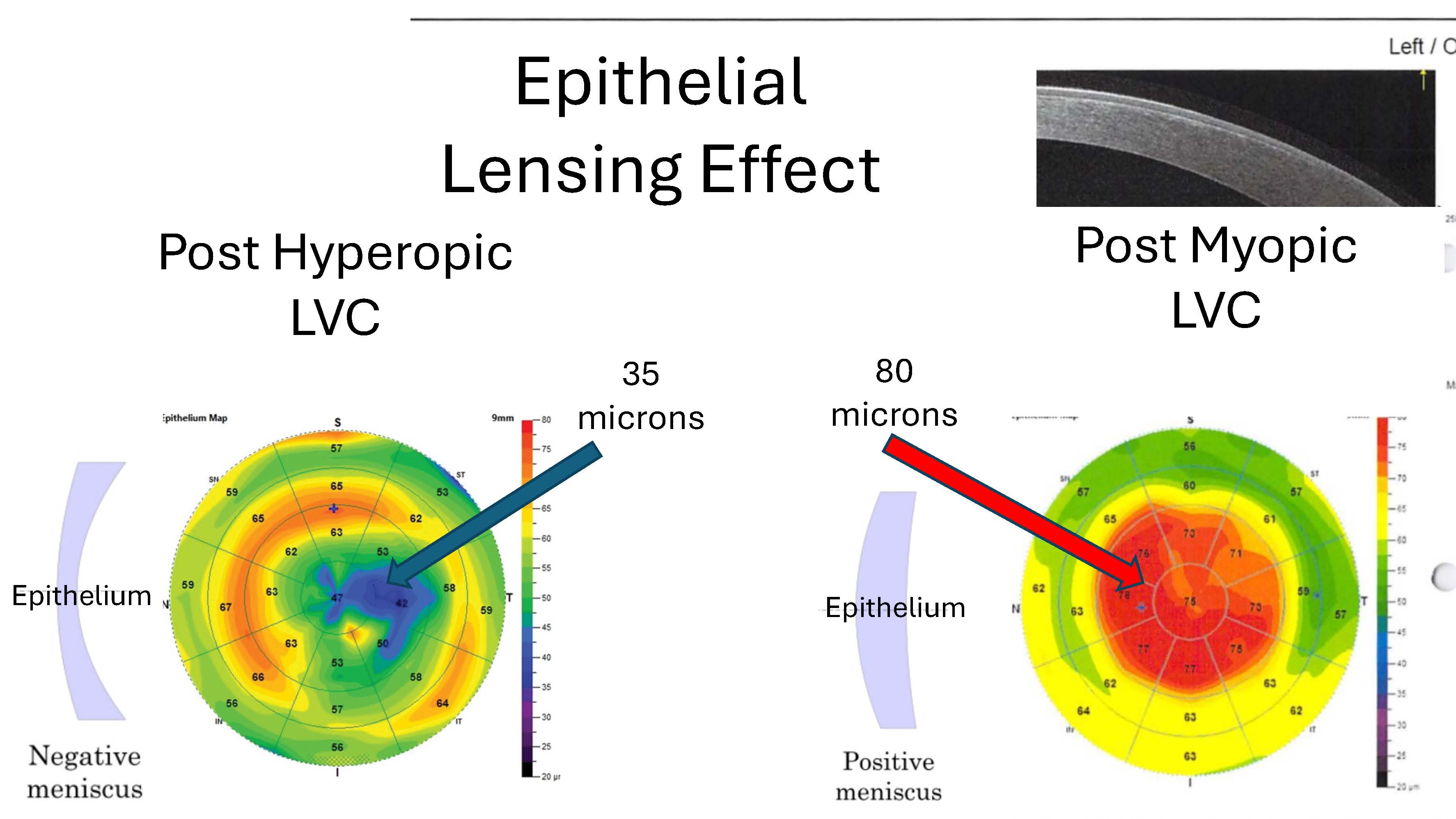 Late Post-LASIK Enhancements