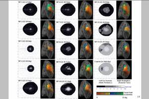 Neuroadaptation/neuroplasticity in multifocal IOLs: role of functional magnetic resonance imaging (FMRI)