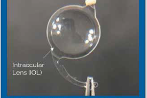Drug-Eluting IOL Haptic Ring May Enable Dropless Cataract Surgery