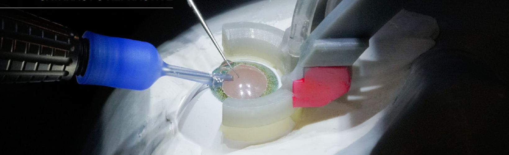 The Robotic Revolution in Cataract Surgery