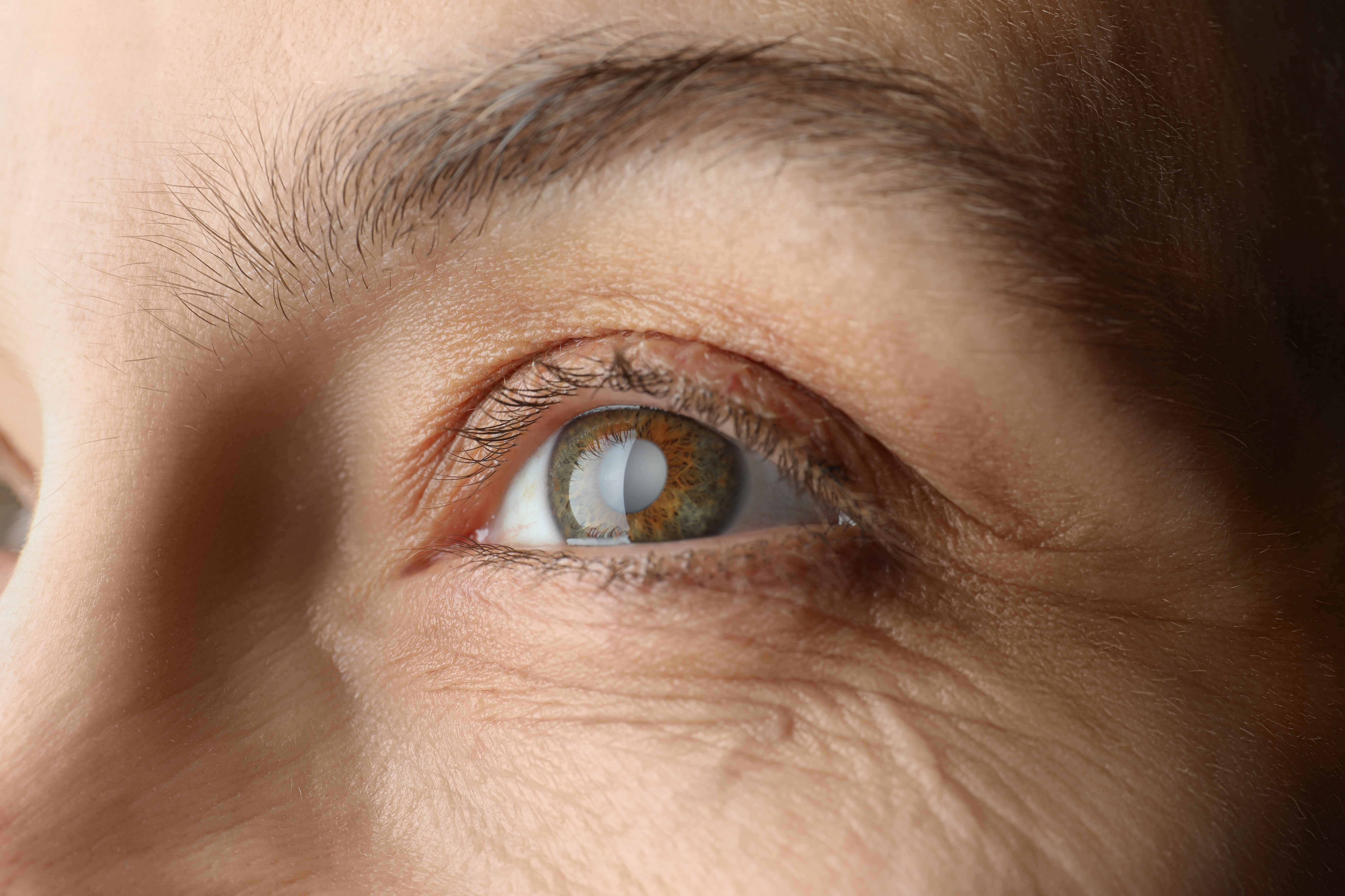 Results of Paul Glaucoma Implant Surgery in Ireland
